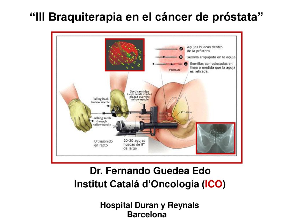 terapia de próstata en línea terapia de próstata en línea